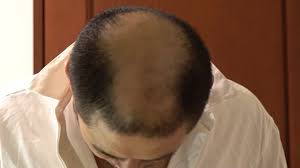あばれる君の頭頂部
